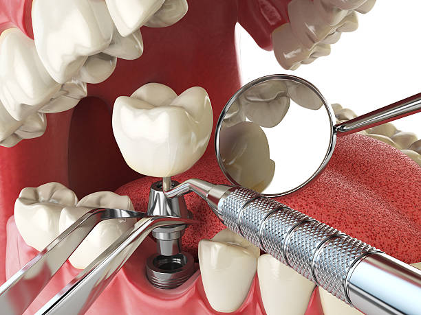 Best Broken or Chipped Tooth Repair in Wells Branch, TX